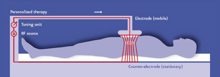 Hyperthermia 