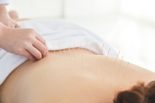 Acupuncture