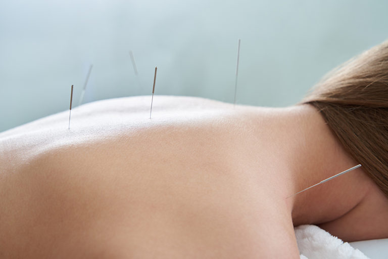 Female back with needles on the acupuncture treatment therapy in spa salon. Alternative Medicine concept