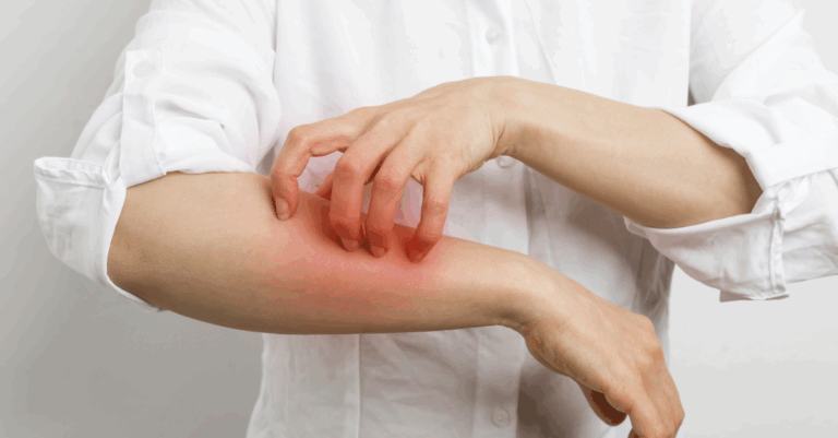 Histamine Intolerance